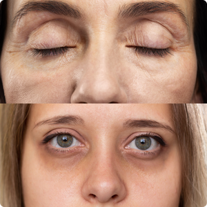 Eyelume™ Under-Eye Light Therapy 23 Eyelume™ Under-Eye Light Therapy